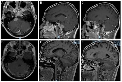 Primary central nervous system post-transplant lymphoproliferative disorder after allogeneic stem cell transplantation: a case report